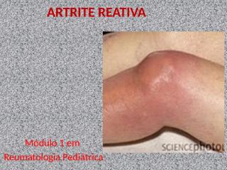 Artrite Reativa.pptx